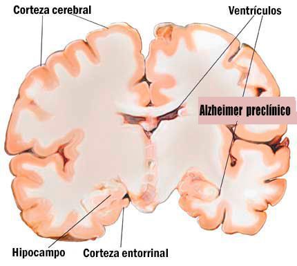 Alzheimer-preclínico
