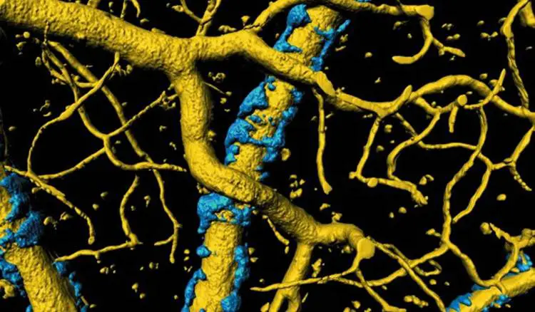 flujo sanguíneo cerebral en la enfermedad de Alzheimer 