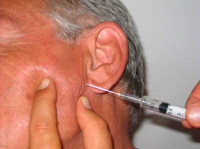 salivación excesiva en la enfermedad de Parkinson