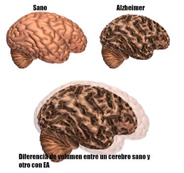 alzhéimer en imágenes