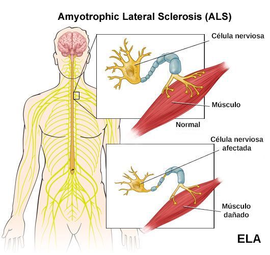 esclerosis lateral amiotrófica