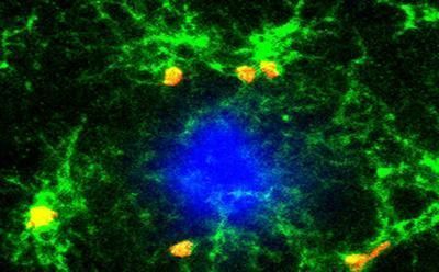 sistema inmunitario como diana terapéutica en la enfermedad de Alzheimer