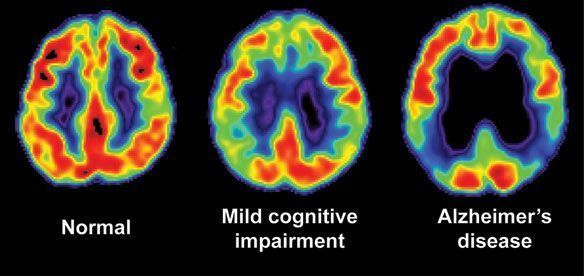 PET cerebral en el diagnóstico de la enfermedad de Alzheimer