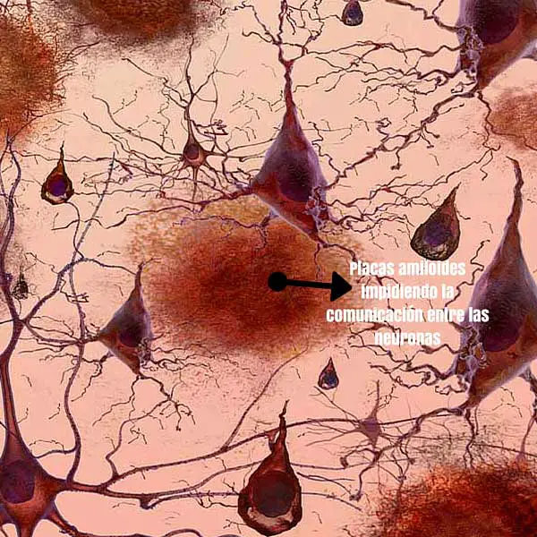 Alzheimer imagen