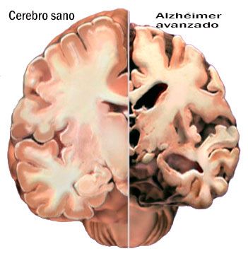 atrofia cerebral en la enfermedad de Alzheimer