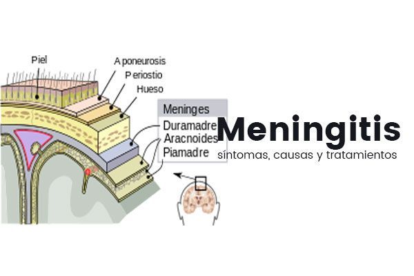 meningitis síntomas
